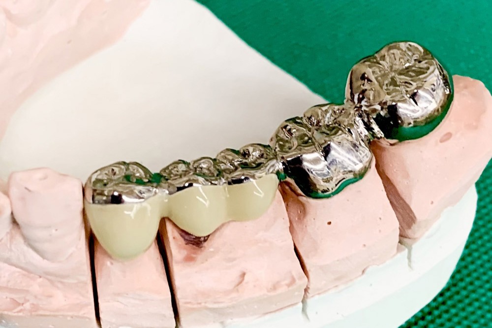 保険のブリッジ