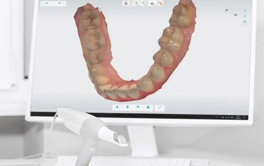 口腔内スキャン