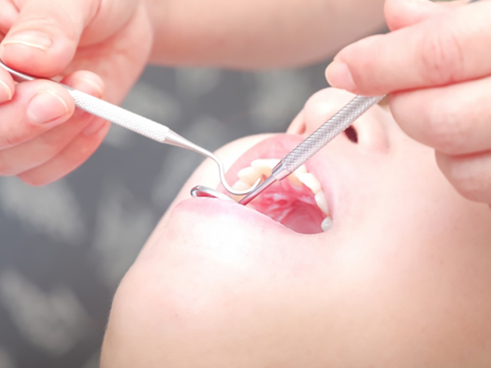 プラークコントロール