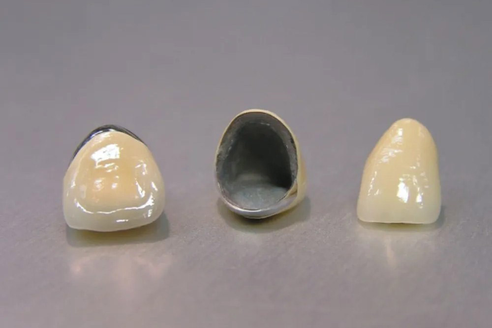 メタルボンドセラミック