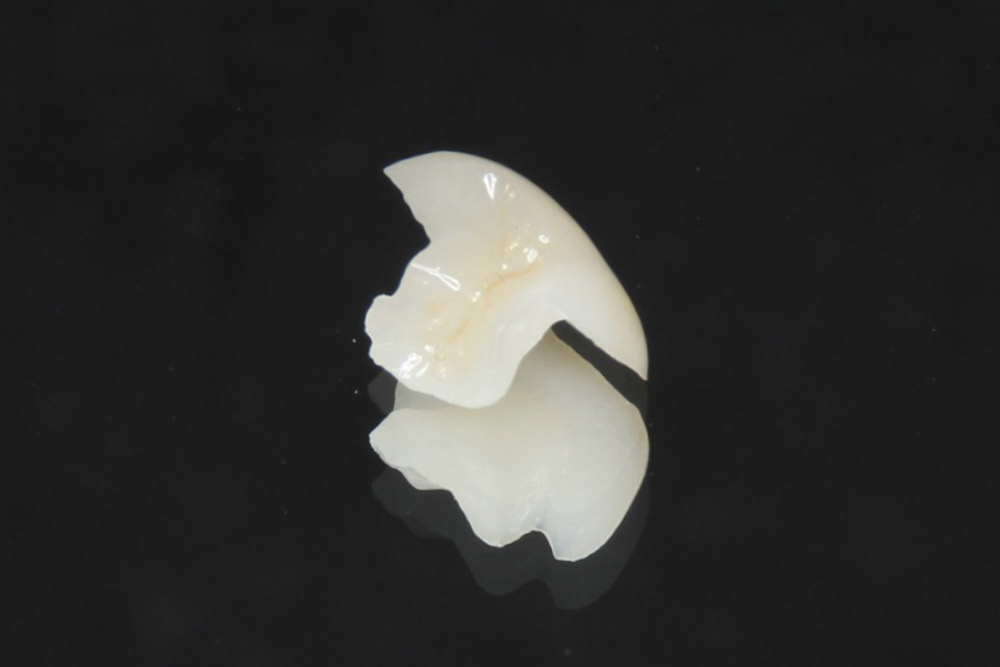 インレー（つめ物）